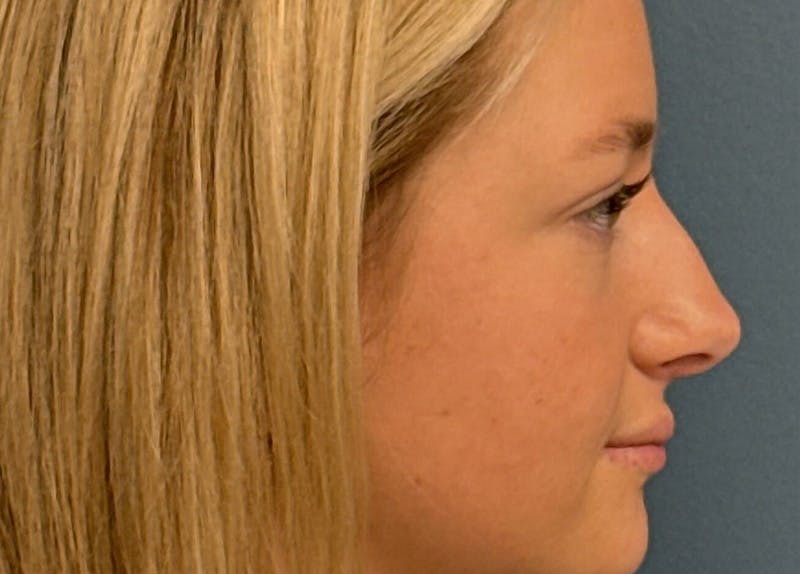 Rhinoplasty Before & After Gallery - Patient 402266 - Image 1