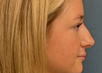 Rhinoplasty Before & After Gallery - Patient 402266 - Image 1