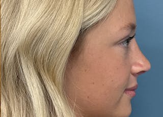 Rhinoplasty Before & After Gallery - Patient 402266 - Image 2
