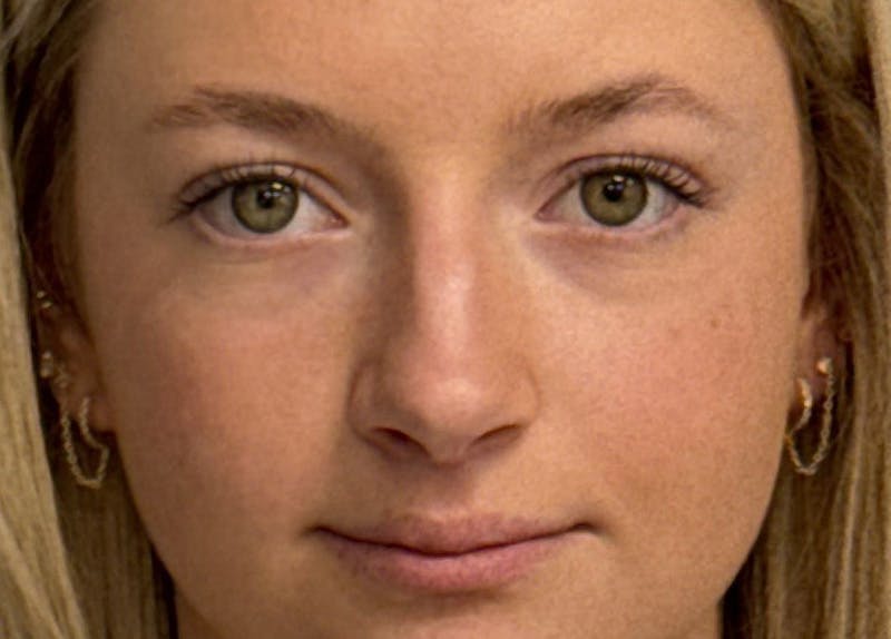 Rhinoplasty Before & After Gallery - Patient 402266 - Image 3