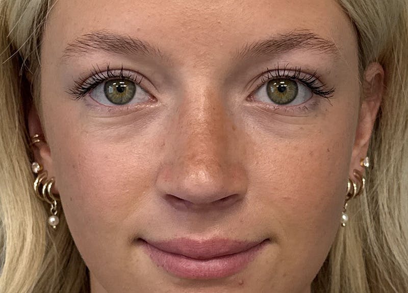 Rhinoplasty Before & After Gallery - Patient 402266 - Image 4