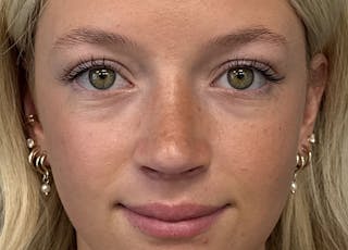 Rhinoplasty Before & After Gallery - Patient 402266 - Image 4