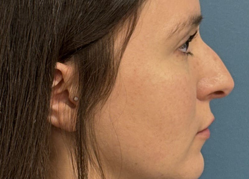 Rhinoplasty Before & After Gallery - Patient 108993 - Image 1