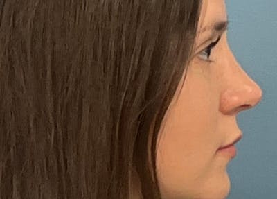 Rhinoplasty Before & After Gallery - Patient 108993 - Image 2