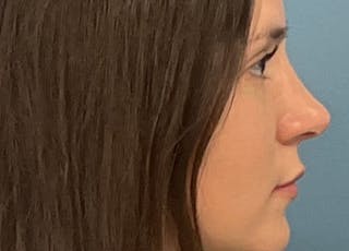 Rhinoplasty Before & After Gallery - Patient 108993 - Image 2