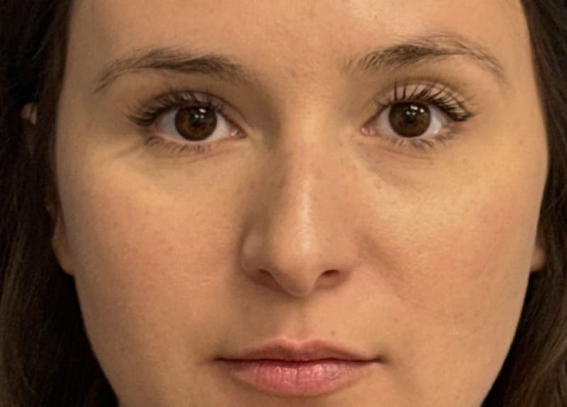 Rhinoplasty Before & After Gallery - Patient 108993 - Image 3