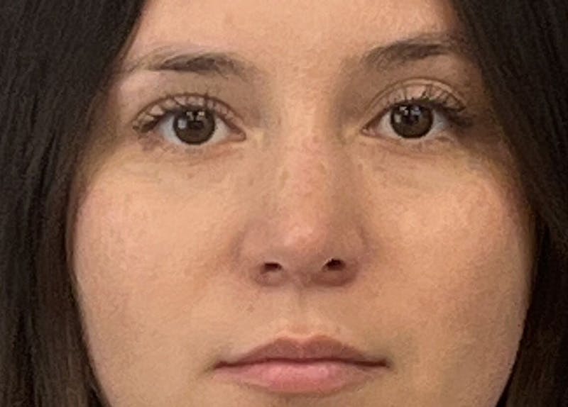 Rhinoplasty Before & After Gallery - Patient 108993 - Image 4