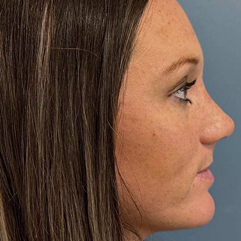 Rhinoplasty Before & After Gallery - Patient 279269 - Image 2