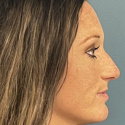 Rhinoplasty Before & After Gallery - Patient 279269 - Image 1