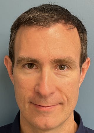 FUE Hair Restoration Before & After Gallery - Patient 402820 - Image 4