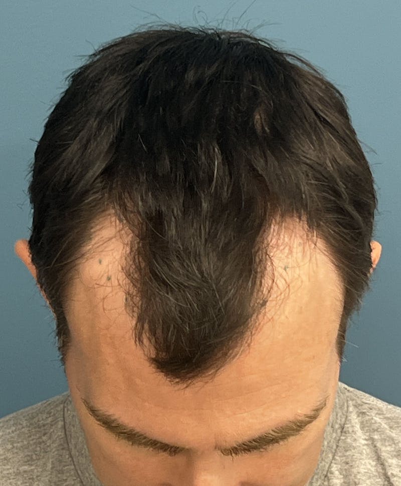 FUE Hair Restoration Before & After Gallery - Patient 402820 - Image 1
