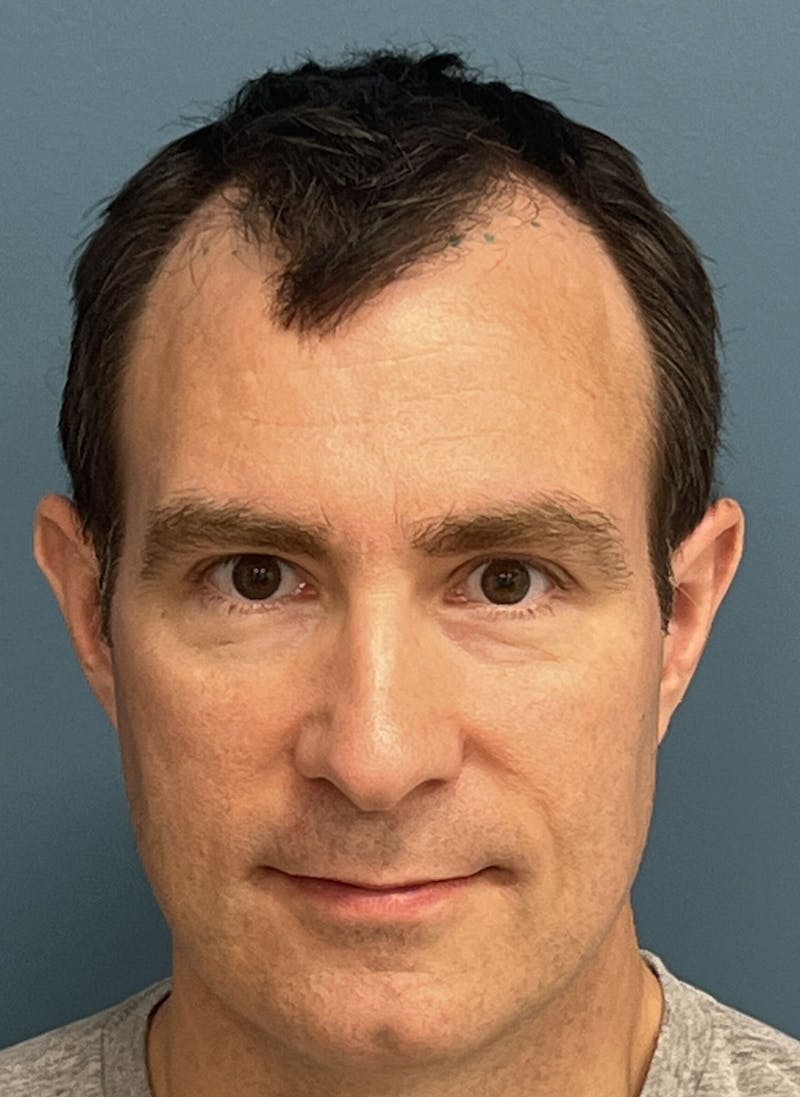 FUE Hair Restoration Before & After Gallery - Patient 402820 - Image 3