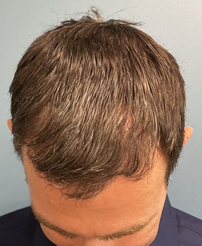 FUE Hair Restoration Before & After Gallery - Patient 402820 - Image 2