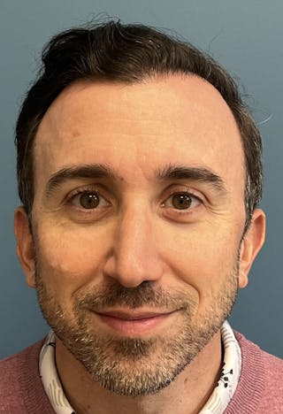 FUE Hair Restoration Before & After Gallery - Patient 822550 - Image 4