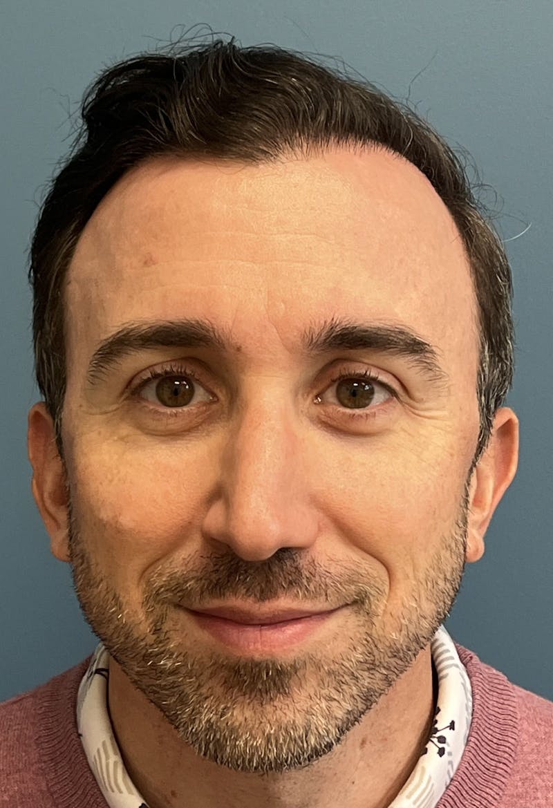 FUE Hair Restoration Before & After Gallery - Patient 822550 - Image 4