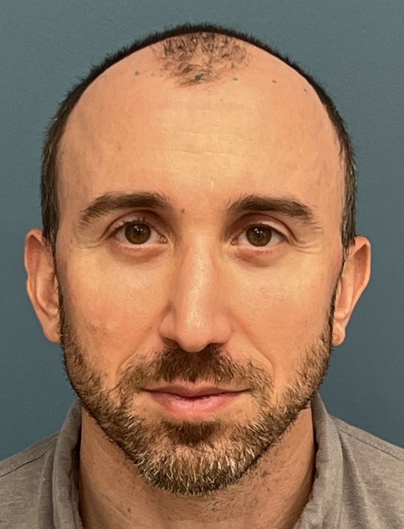 FUE Hair Restoration Before & After Gallery - Patient 822550 - Image 3