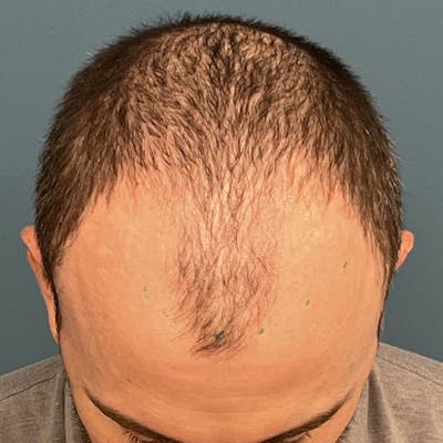 FUE Hair Restoration Before & After Gallery - Patient 822550 - Image 1