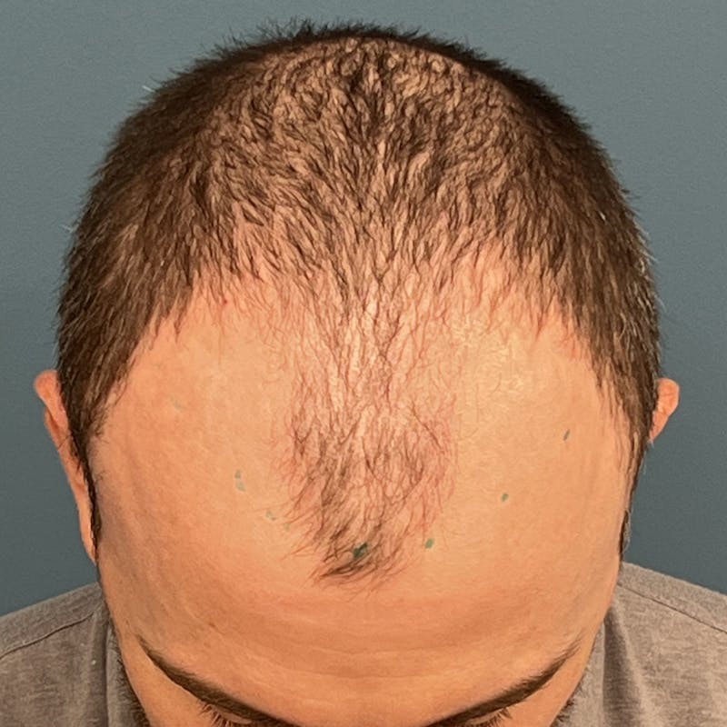 FUE Hair Restoration Before & After Gallery - Patient 822550 - Image 1