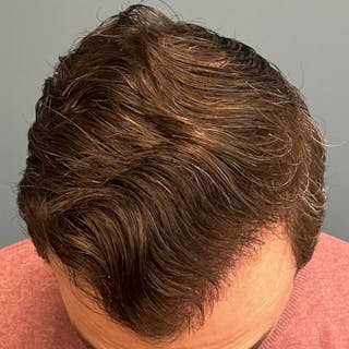 FUE Hair Restoration Before & After Gallery - Patient 822550 - Image 2