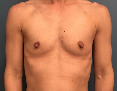 Breast Augmentation Before & After Gallery - Patient 194889 - Image 1