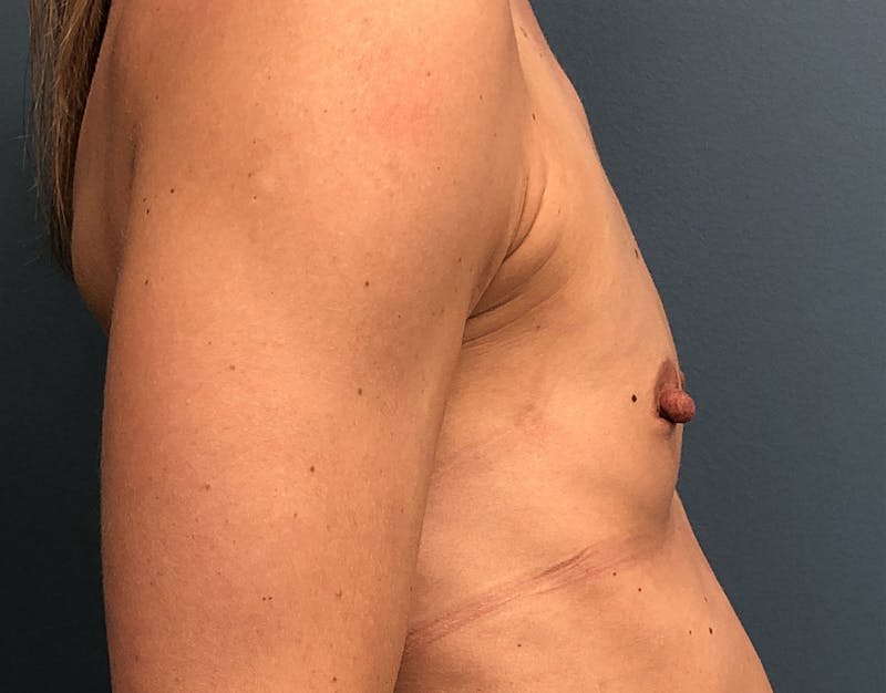 Breast Augmentation Before & After Gallery - Patient 194889 - Image 3