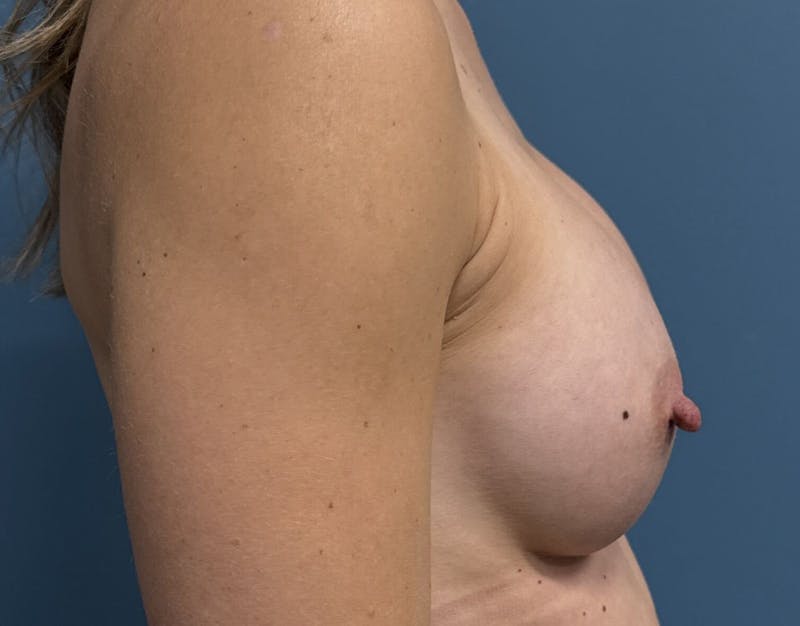 Breast Augmentation Before & After Gallery - Patient 194889 - Image 4