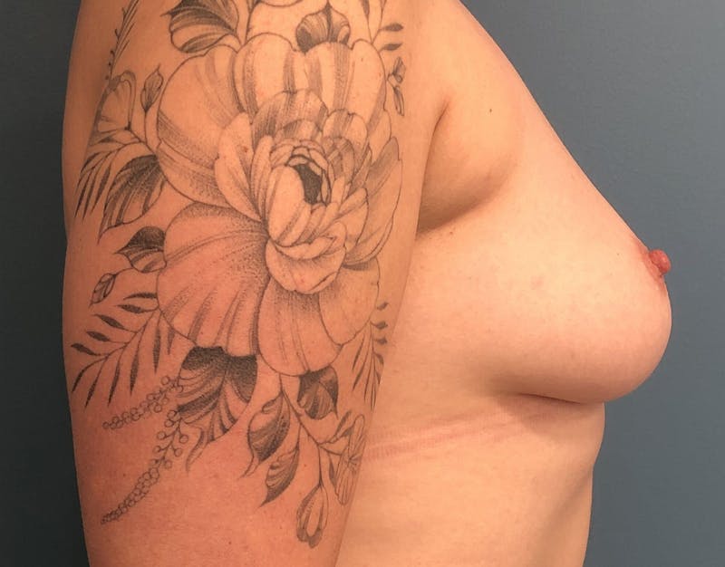 Breast Augmentation Before & After Gallery - Patient 229119 - Image 3