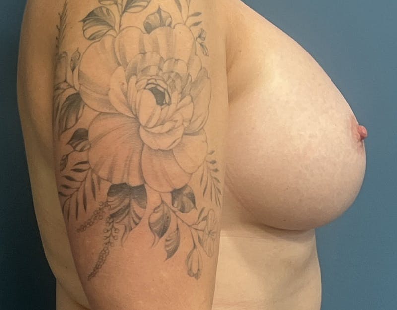 Breast Augmentation Before & After Gallery - Patient 229119 - Image 4
