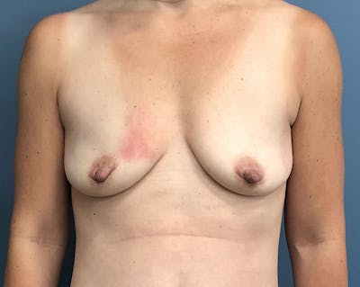 Breast Augmentation with Lift Before & After Gallery - Patient 356619 - Image 1