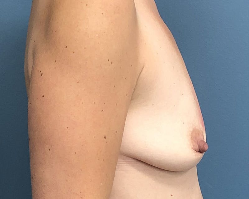 Breast Augmentation with Lift Before & After Gallery - Patient 356619 - Image 3