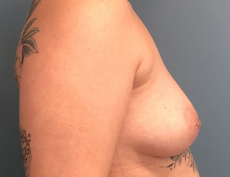 Breast Augmentation with Lift Before & After Gallery - Patient 299715 - Image 3