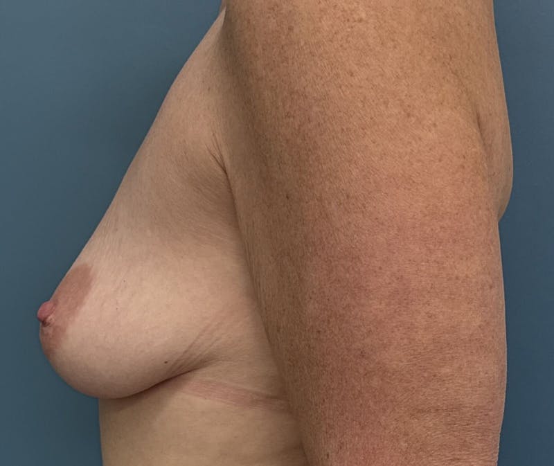 Breast Augmentation with Lift Before & After Gallery - Patient 334996 - Image 3