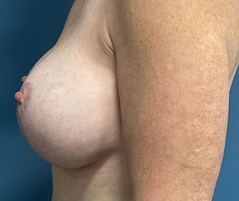 Breast Augmentation with Lift Before & After Gallery - Patient 334996 - Image 4
