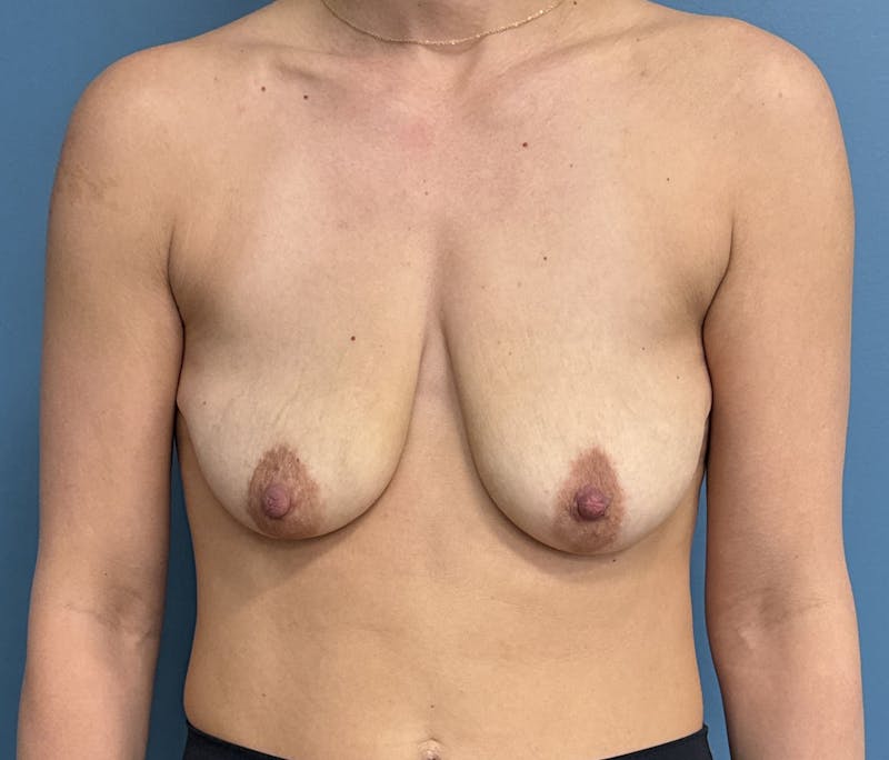 Breast Lift Before & After Gallery - Patient 401304 - Image 1