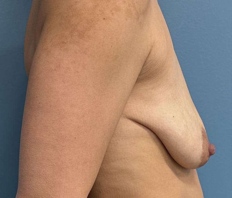 Breast Lift Before & After Gallery - Patient 401304 - Image 3