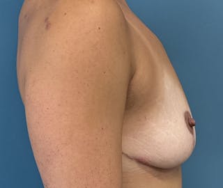 Breast Reduction Before & After Gallery - Patient 387631 - Image 4
