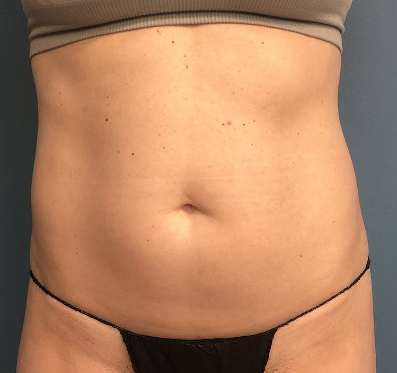 Liposuction Before & After Gallery - Patient 812843 - Image 1
