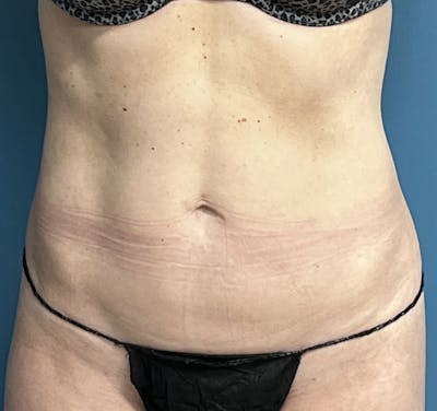 Liposuction Before & After Gallery - Patient 812843 - Image 2