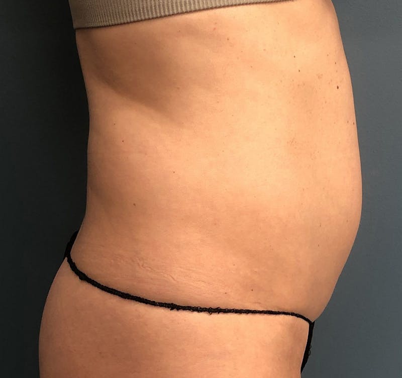 Liposuction Before & After Gallery - Patient 812843 - Image 3