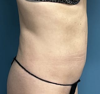 Liposuction Before & After Gallery - Patient 812843 - Image 4