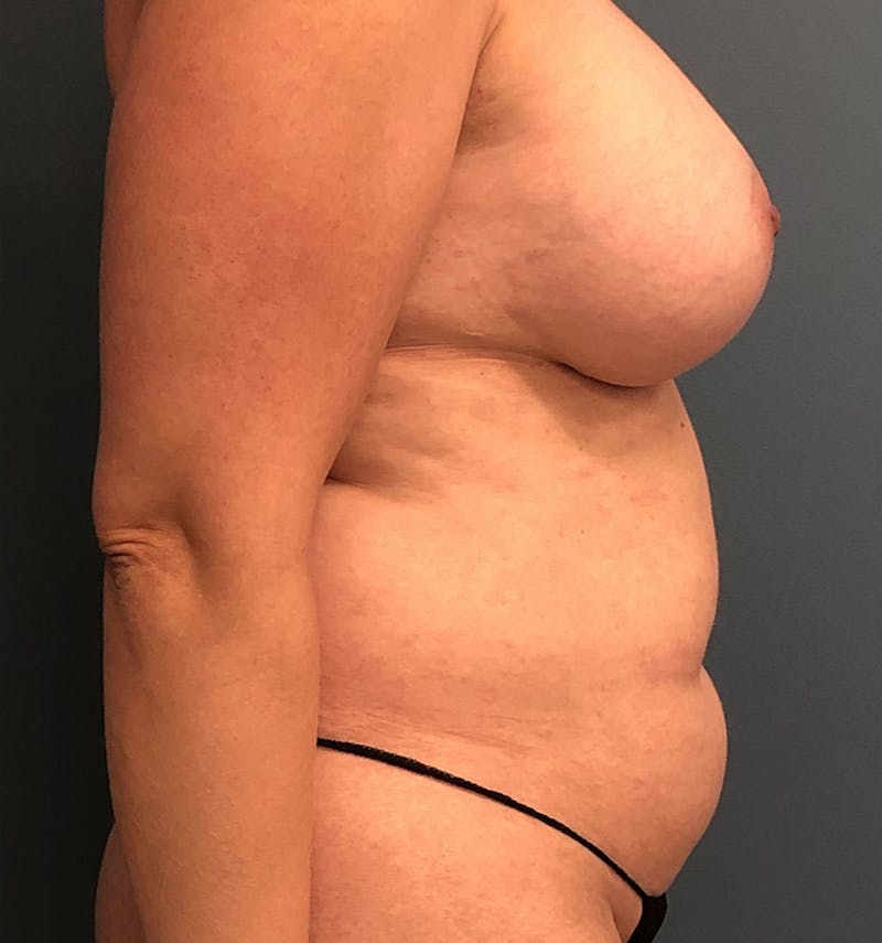 Mommy Makeover Before & After Gallery - Patient 484168 - Image 3