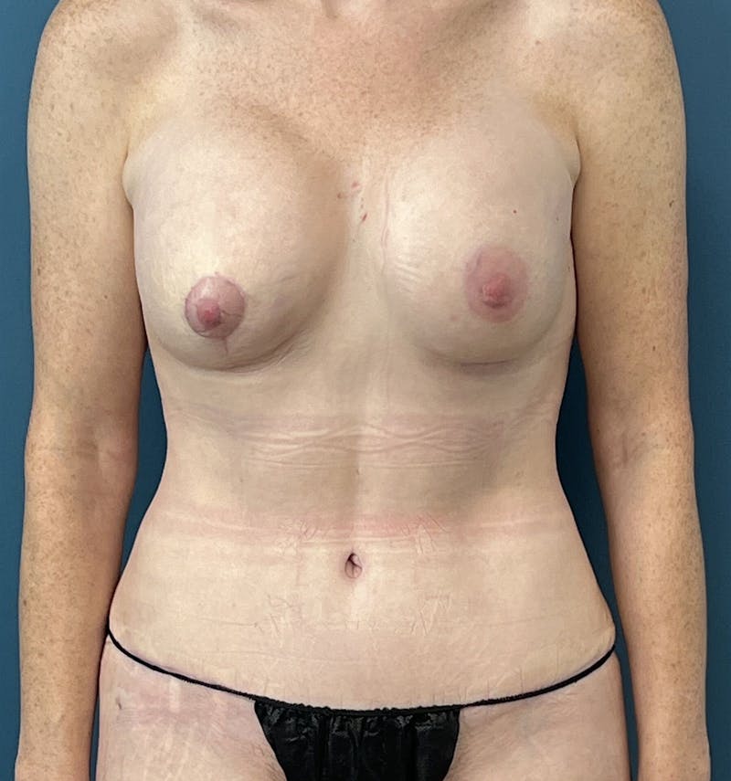 Mommy Makeover Before & After Gallery - Patient 282230 - Image 2