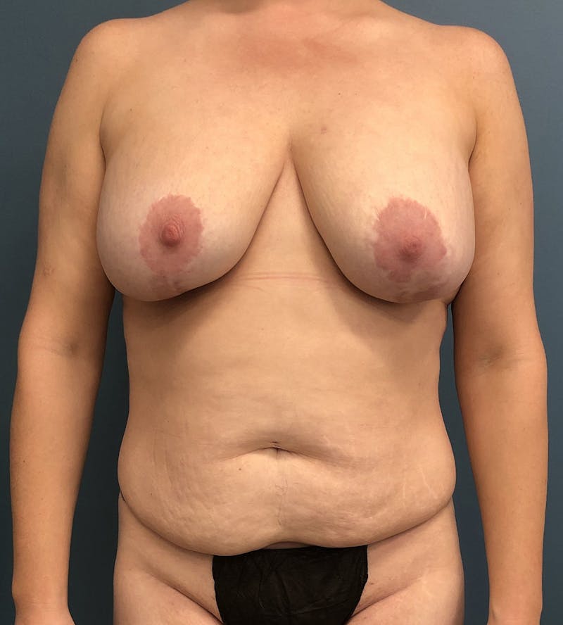 Mommy Makeover Before & After Gallery - Patient 163759 - Image 1
