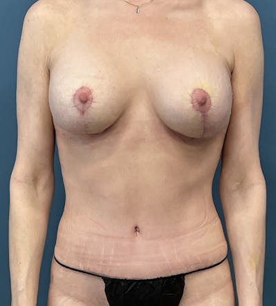 Mommy Makeover Before & After Gallery - Patient 163759 - Image 2