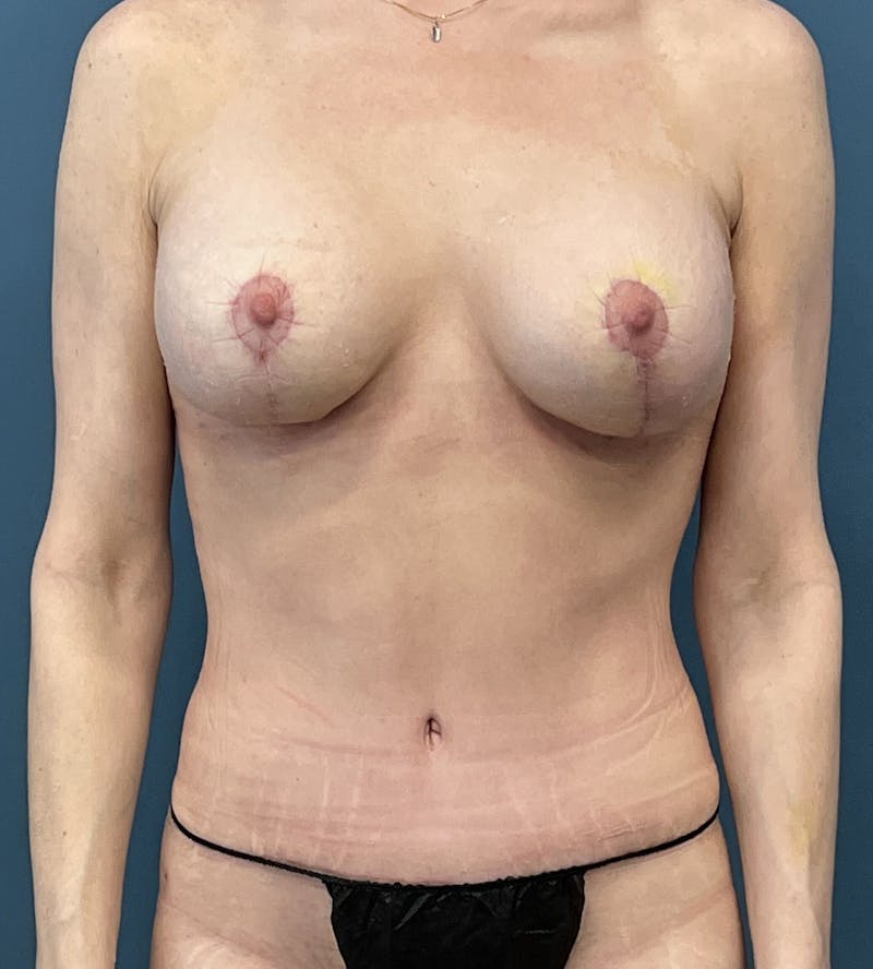 Mommy Makeover Before & After Gallery - Patient 163759 - Image 2