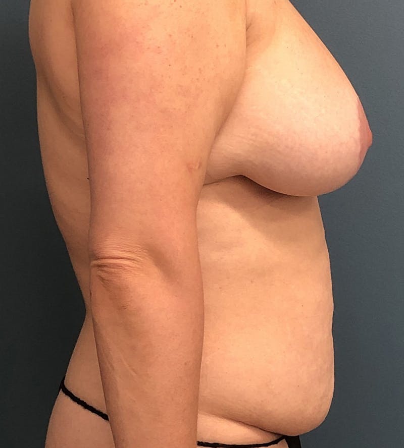 Mommy Makeover Before & After Gallery - Patient 163759 - Image 3