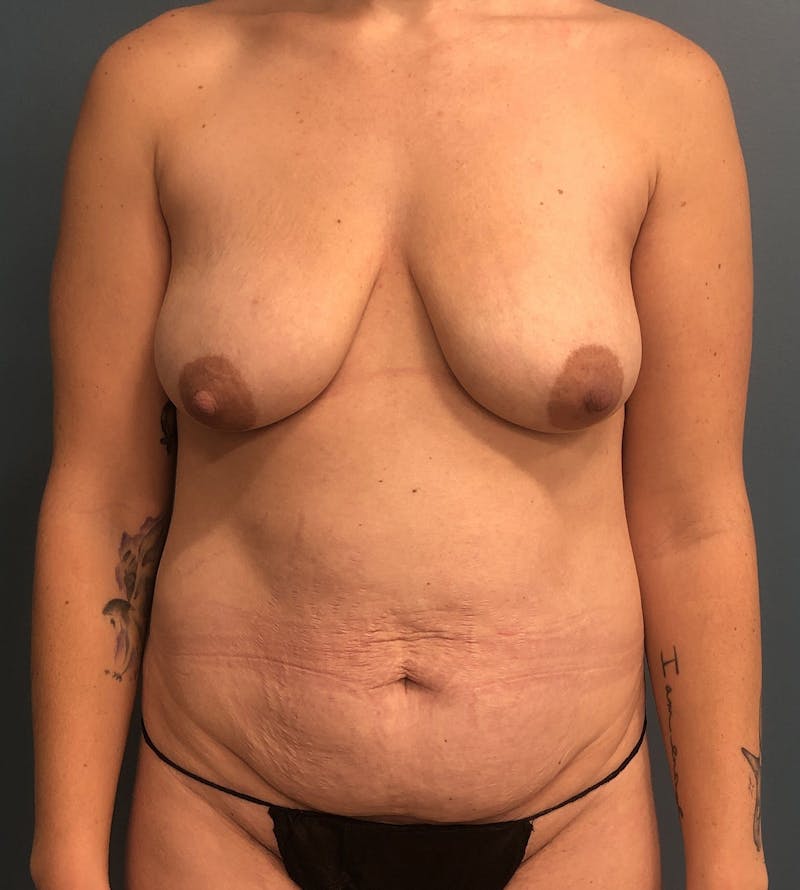 Mommy Makeover Before & After Gallery - Patient 471547 - Image 1