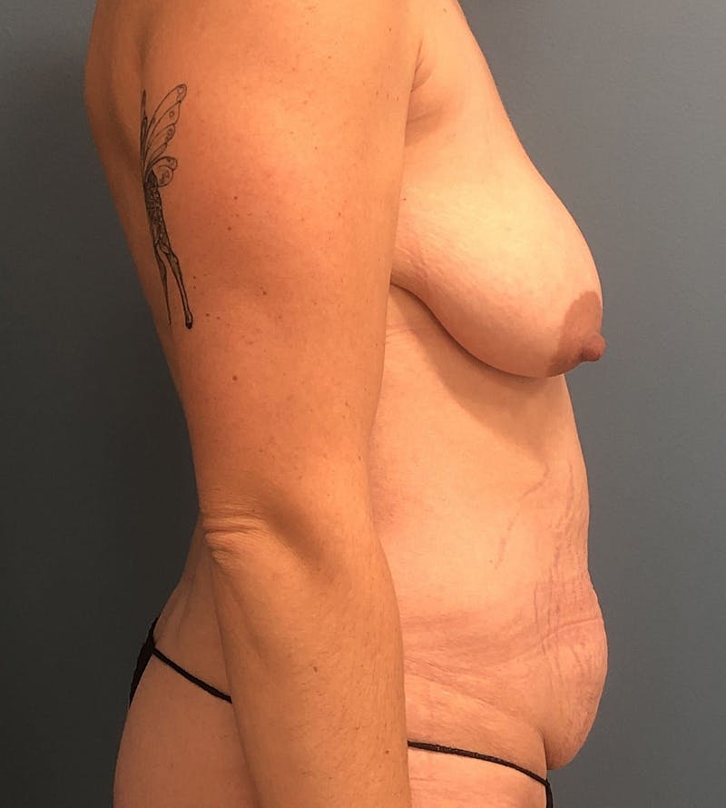 Mommy Makeover Before & After Gallery - Patient 471547 - Image 3