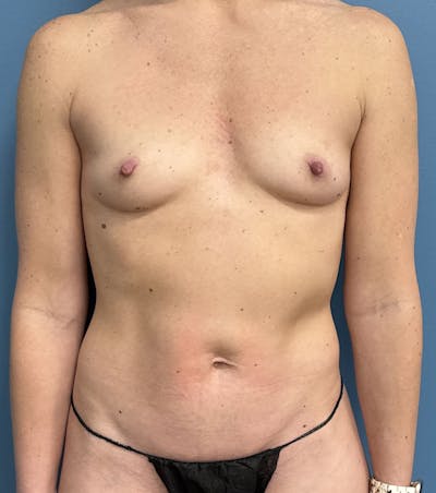 Mommy Makeover Before & After Gallery - Patient 347705 - Image 1