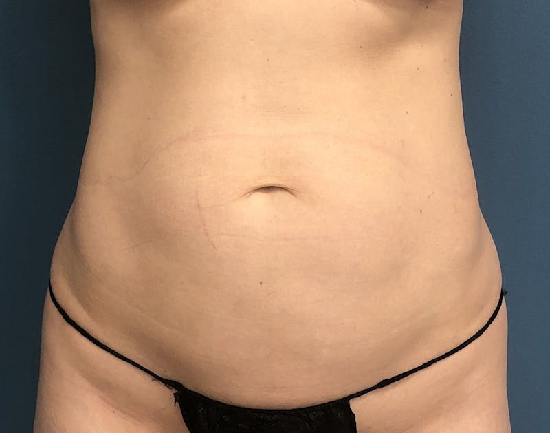 Powertuck Before & After Gallery - Patient 390821 - Image 1